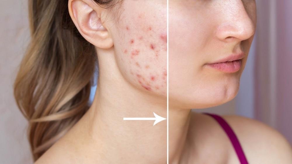 Latest Acne Removal Methods in Dubai